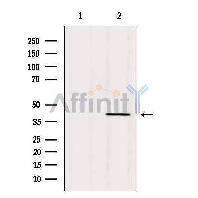 DF12333 at 1/100 staining Human lymph cancer tissue by IHC-P. The sample was formaldehyde fixed and a heat mediated antigen retrieval step in citrate buffer was performed. The sample was then blocked and incubated with the antibody for 1.5 hours at 22¡ãC. An HRP conjugated goat anti-rabbit antibody was used as the secondary