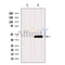 DF12351 at 1/100 staining Human lymph cancer tissue by IHC-P. The sample was formaldehyde fixed and a heat mediated antigen retrieval step in citrate buffer was performed. The sample was then blocked and incubated with the antibody for 1.5 hours at 22¡ãC. An HRP conjugated goat anti-rabbit antibody was used as the secondary