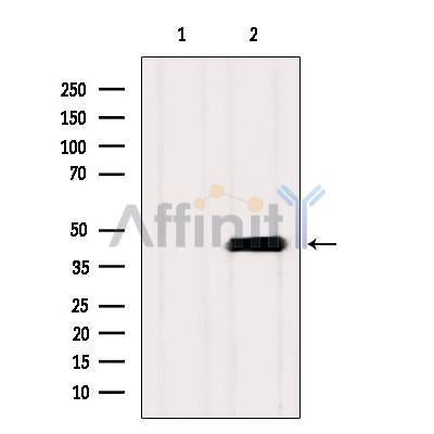 DF12351 at 1/100 staining Human lymph cancer tissue by IHC-P. The sample was formaldehyde fixed and a heat mediated antigen retrieval step in citrate buffer was performed. The sample was then blocked and incubated with the antibody for 1.5 hours at 22¡ãC. An HRP conjugated goat anti-rabbit antibody was used as the secondary