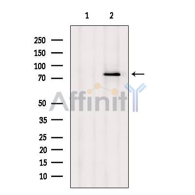 DF12418 at 1/100 staining Human pancreas cancer tissue by IHC-P. The sample was formaldehyde fixed and a heat mediated antigen retrieval step in citrate buffer was performed. The sample was then blocked and incubated with the antibody for 1.5 hours at 22¡ãC. An HRP conjugated goat anti-rabbit antibody was used as the secondary