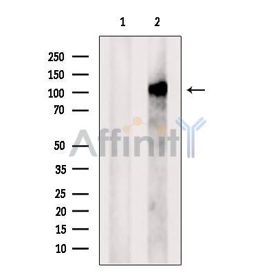 DF12441 at 1/100 staining Human pancreas cancer tissue by IHC-P. The sample was formaldehyde fixed and a heat mediated antigen retrieval step in citrate buffer was performed. The sample was then blocked and incubated with the antibody for 1.5 hours at 22¡ãC. An HRP conjugated goat anti-rabbit antibody was used as the secondary