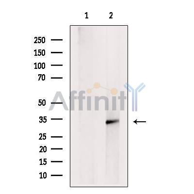 DF12447 at 1/100 staining Human pancreas cancer tissue by IHC-P. The sample was formaldehyde fixed and a heat mediated antigen retrieval step in citrate buffer was performed. The sample was then blocked and incubated with the antibody for 1.5 hours at 22¡ãC. An HRP conjugated goat anti-rabbit antibody was used as the secondary