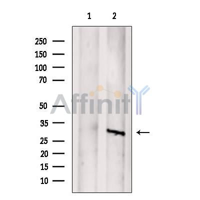 DF12469 at 1/100 staining Human thyroid cancer tissue by IHC-P. The sample was formaldehyde fixed and a heat mediated antigen retrieval step in citrate buffer was performed. The sample was then blocked and incubated with the antibody for 1.5 hours at 22¡ãC. An HRP conjugated goat anti-rabbit antibody was used as the secondary