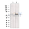 DF12475 at 1/100 staining Human thyroid cancer tissue by IHC-P. The sample was formaldehyde fixed and a heat mediated antigen retrieval step in citrate buffer was performed. The sample was then blocked and incubated with the antibody for 1.5 hours at 22¡ãC. An HRP conjugated goat anti-rabbit antibody was used as the secondary
