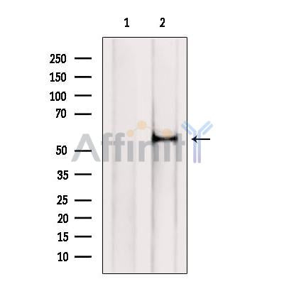 DF12475 at 1/100 staining Human thyroid cancer tissue by IHC-P. The sample was formaldehyde fixed and a heat mediated antigen retrieval step in citrate buffer was performed. The sample was then blocked and incubated with the antibody for 1.5 hours at 22¡ãC. An HRP conjugated goat anti-rabbit antibody was used as the secondary