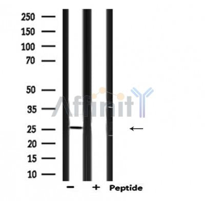 DF6194 at 1/100 staining Human Melanoma tissue by IHC-P. The sample was formaldehyde fixed and a heat mediated antigen retrieval step in citrate buffer was performed. The sample was then blocked and incubated with the antibody for 1.5 hours at 22¡ãC. An HRP conjugated goat anti-rabbit antibody was used as the secondary