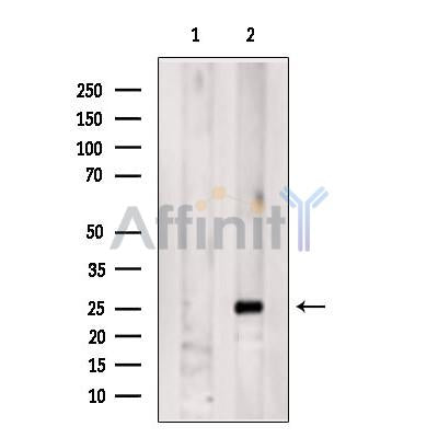 DF6742 at 1/100 staining Human Melanoma tissue by IHC-P. The sample was formaldehyde fixed and a heat mediated antigen retrieval step in citrate buffer was performed. The sample was then blocked and incubated with the antibody for 1.5 hours at 22¡ãC. An HRP conjugated goat anti-rabbit antibody was used as the secondary