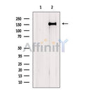 DF9032 at 1/100 staining Human liver cancer tissue by IHC-P. The sample was formaldehyde fixed and a heat mediated antigen retrieval step in citrate buffer was performed. The sample was then blocked and incubated with the antibody for 1.5 hours at 22¡ãC. An HRP conjugated goat anti-rabbit antibody was used as the secondary