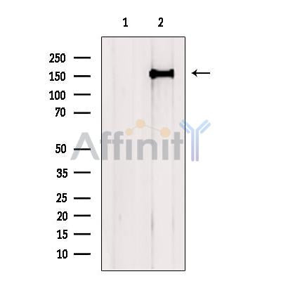 DF9032 at 1/100 staining Human liver cancer tissue by IHC-P. The sample was formaldehyde fixed and a heat mediated antigen retrieval step in citrate buffer was performed. The sample was then blocked and incubated with the antibody for 1.5 hours at 22¡ãC. An HRP conjugated goat anti-rabbit antibody was used as the secondary